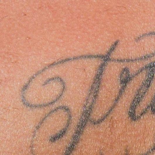 Small Tattoo Removal Package